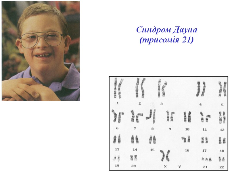Синдром Дауна (трисомія 21)‏